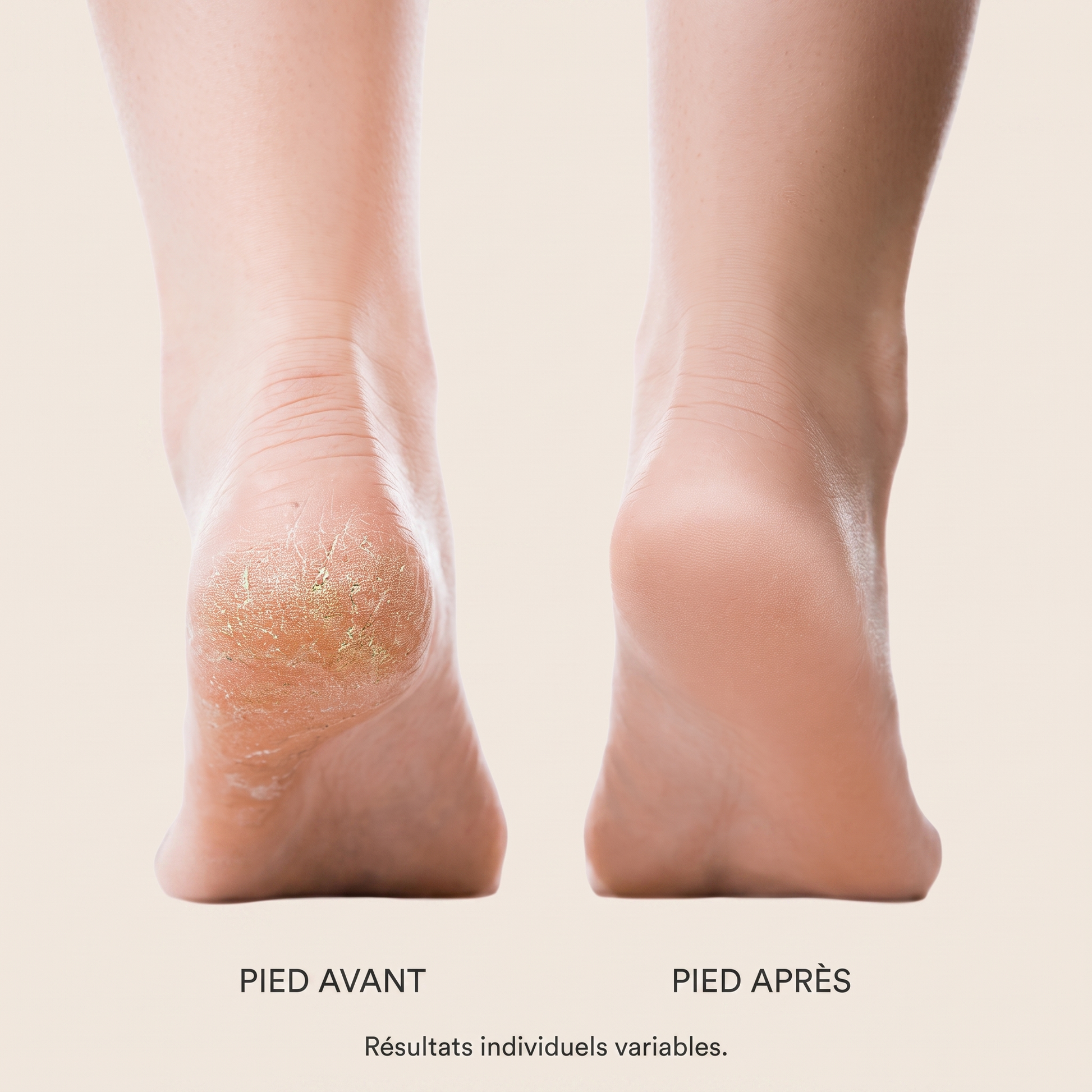 Pied avant / après Lisséa — peau plus douce. Résultats individuels variables