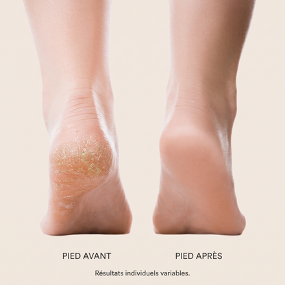 Pied avant / après Lisséa — peau plus douce. Résultats individuels variables